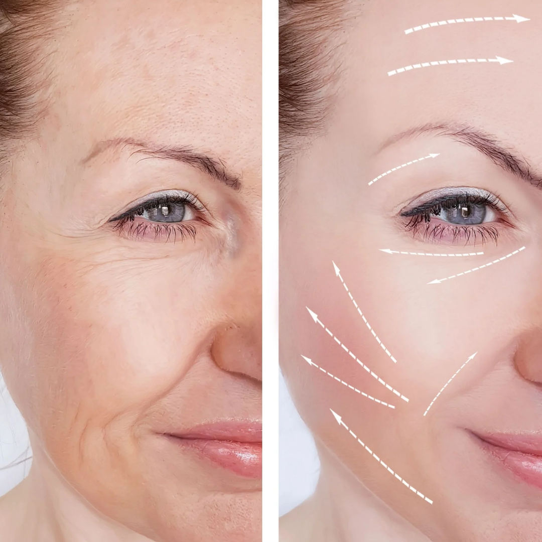 Masajeador Facial ionico ANTIARRUGAS DERMALIGHT™